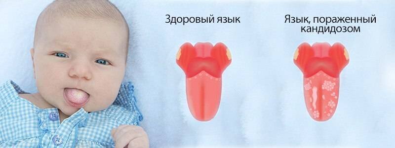 Детская стоматология KidsDental: Налет на языке у ребенка – стоит ли беспокоиться?