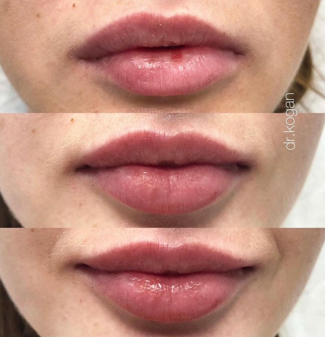 Коррекции губ Juvederm Volift. Фото из инстаграм lidiakogan. Имеются противопоказания, требуется консультация