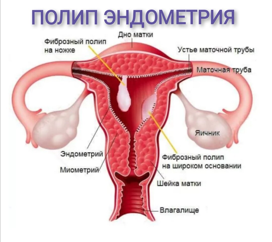 Полип в эндометрии матки отзывы