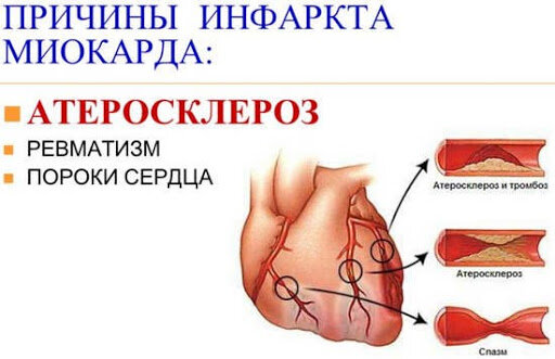 Причины инфаркта миокарда