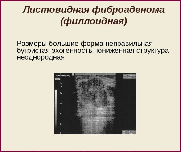Как выглядит фиброаденома после удаления Доброкачественные опухоли молочной железы - киста, фиброаденома и листовидная оп