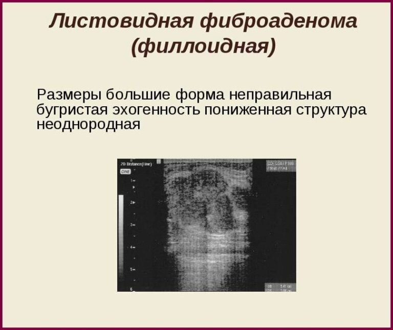 Фиброаденома молочной железы причины, диагностика и лечение.