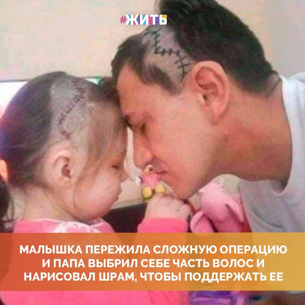 На что только не пойдут родители ради своих детей❤️🤲

Маленькая девочка пережила сложную операцию. После у этого на голове остался некрасивый шрам и малышка очень его стеснялась😢

Как хорошо, что у нее есть свой собственный герой - ее папа, который сделал себе точно такой же шрам, чтобы девочка чувствовала себя комфортнее ☝️

Берегите своих родителей! Их обнови бесценна💗

#жить #проектжить #папы