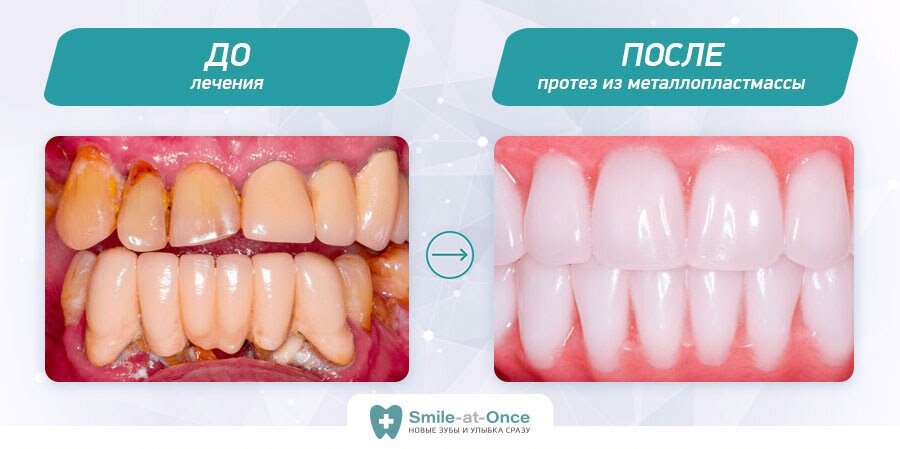 До и после all-on-4: адаптационный легкий протез с металлическим каркасом, который был установлен на 3 день после вживления имплантов. Фото: Smile-at-Once
