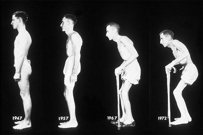 Так прогрессирует болезнь Бехтерева. Человек не может повернуться, держать спину и наклониться, не испытывая боль