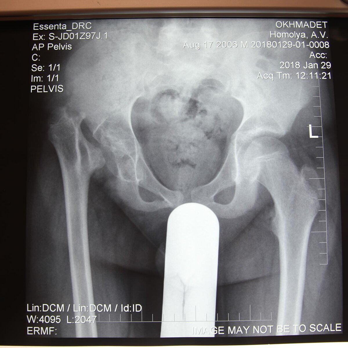 Рентген патологии