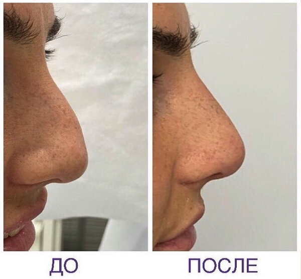 Пример безоперационной ринопластики Фото © Instagram / morozolga_beauty 