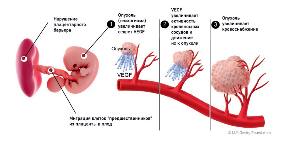 Развитие младенческой гемангиомы у плода. Иллюстрация из книги "Гемангиома" автор Романов Д.В. 2022