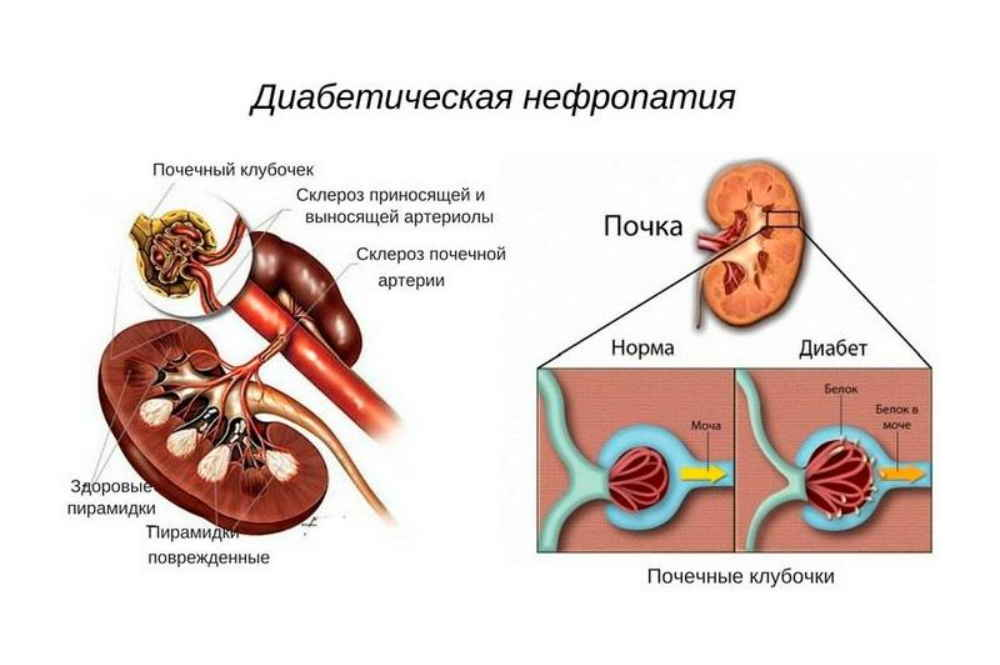 Почему в почках белок. Осложнения сахарного диабета - нефропатия. Диабетическая нефропатия (патология почек);. Сахарный диабет 2 типа нефропатия. Нефропатия при сахарном диабете 2.