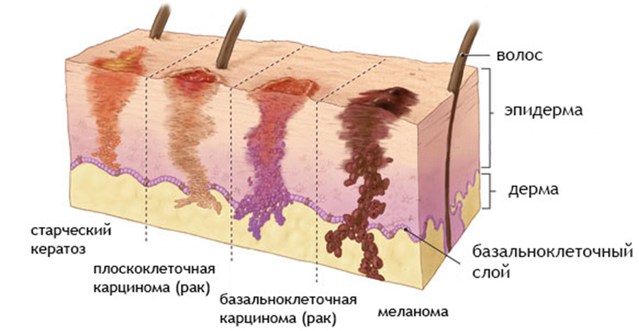 Базальноклеточный рак кожи