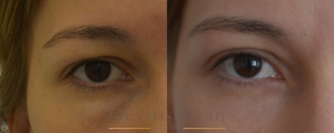 Блефаропластика нижнего века фото до и после. Фото с сайта Д.Р. Гришкяна. Имеются противопоказания, требуется консультация специалиста