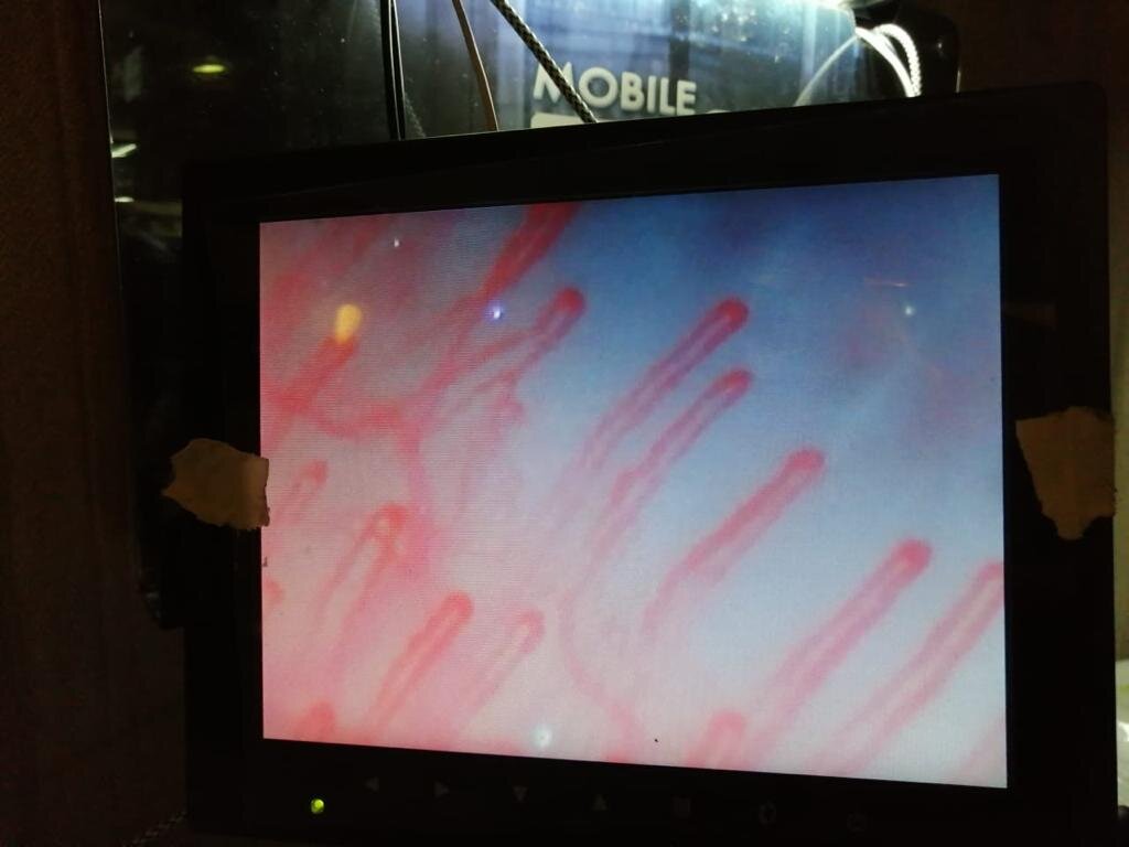 Изображения капилляров на мониторе