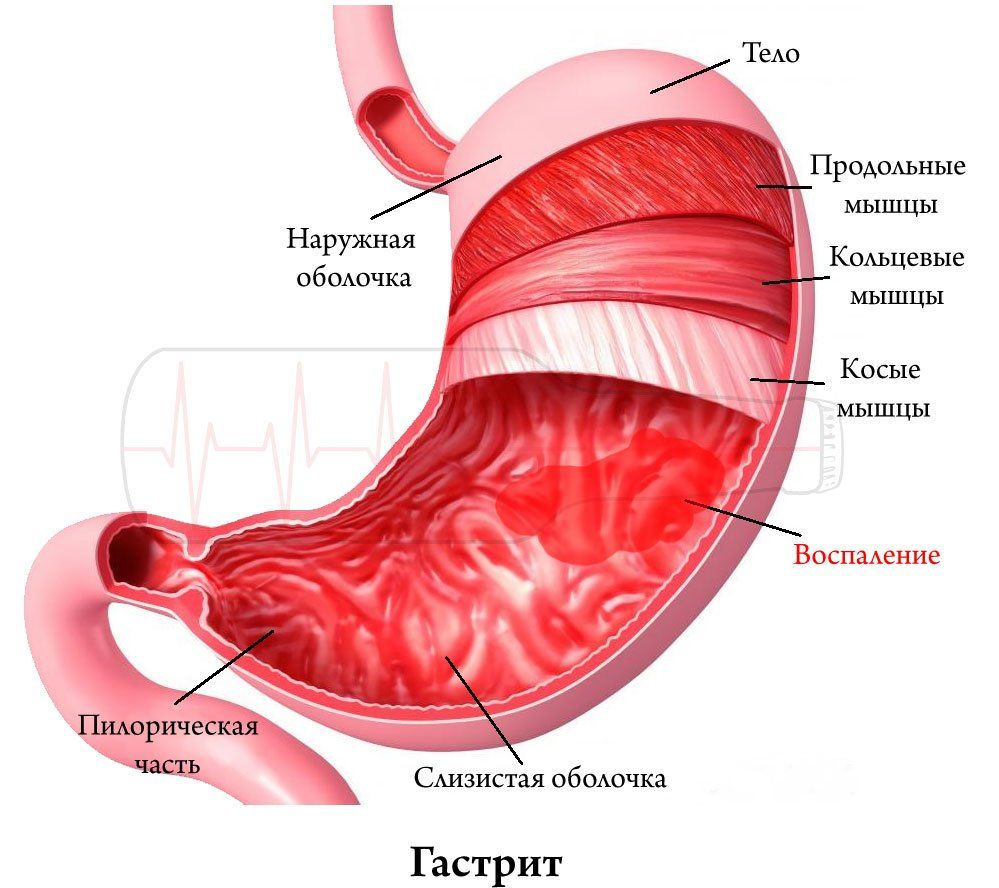 Гастрит - лечение народными средствами