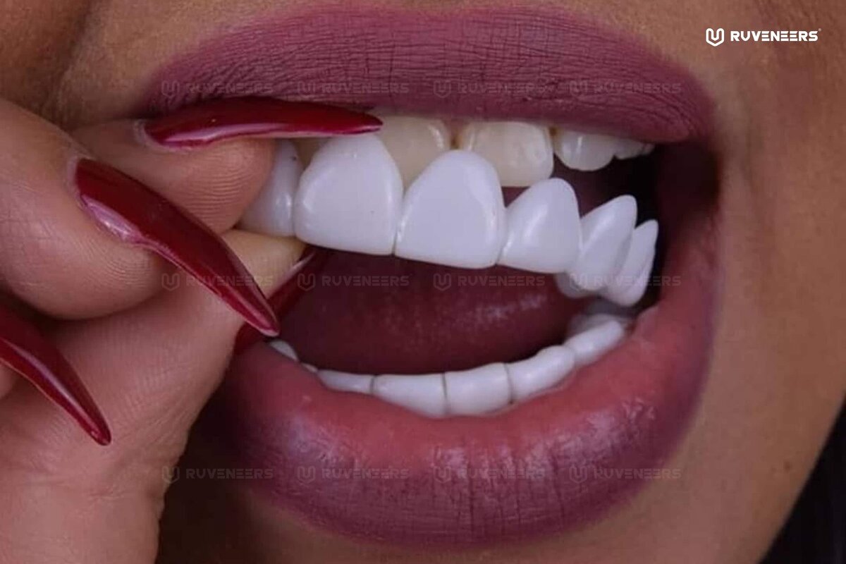 RUVENEERS надеваются на зубы за доли секунд 