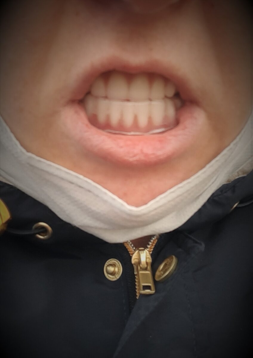 капа в первый день носки