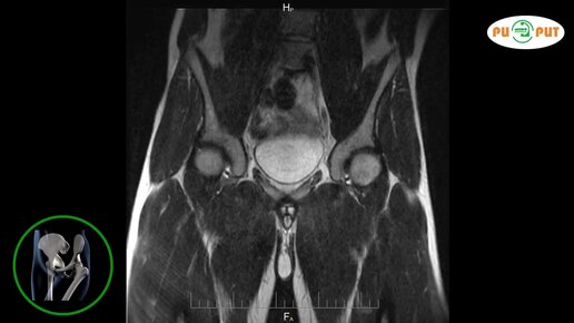 Как делают МРТ тазобедренного сустава