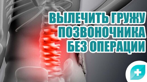 Можно ли удалить грыжу позвоночника без операции? | Первая Медицинская ...