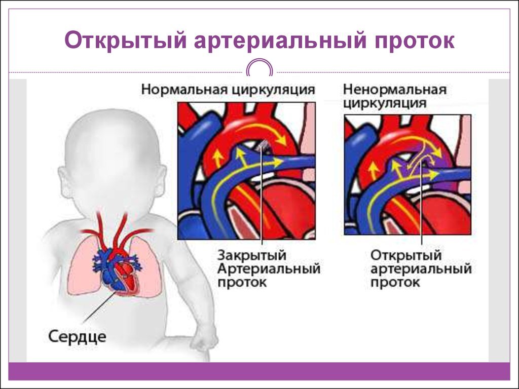 Открытый артериальный проток картинки