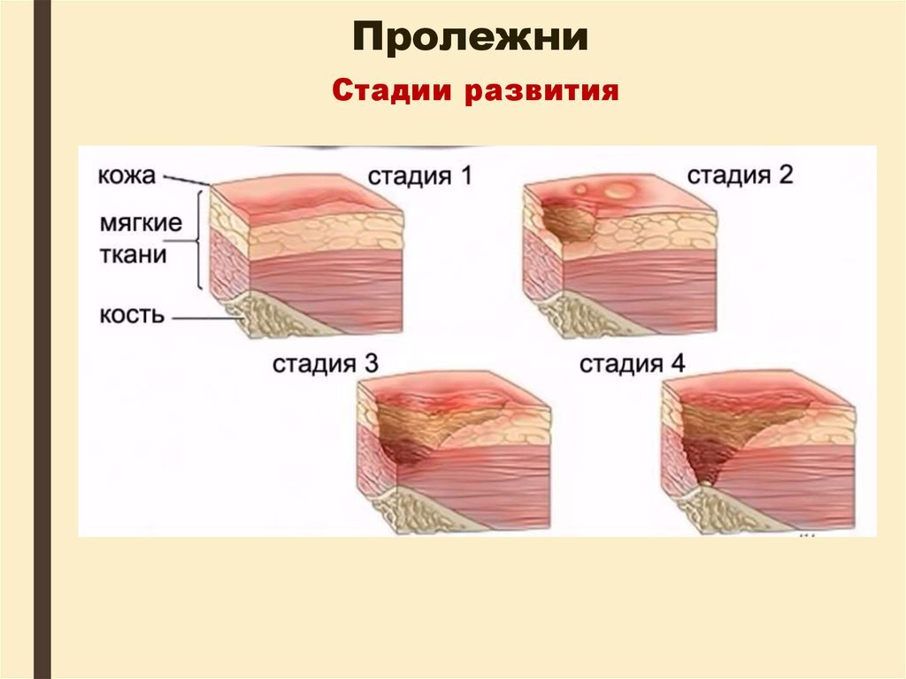 1 стадия пролежней фото