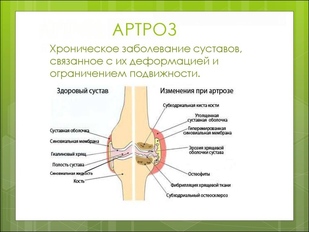 Поражение крупных суставов