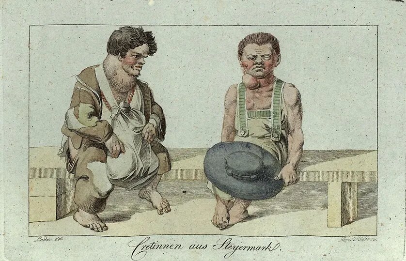 Врожденный гипотиреоз, гравюра, Вена, 1819 год. 
