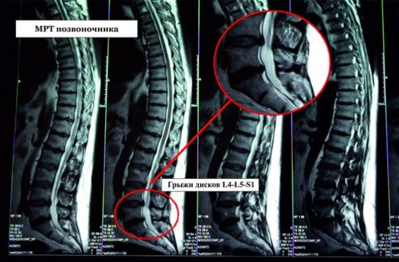 Может ли грыжа позвоночника. Мрт крестцово поясничного отдела грыжа. Мрт пояснично-крестцового отдела позвоночника грыжа. Снимок мрт грыжи позвоночном отделе. Межпозвонковая грыжа крестцового отдела.