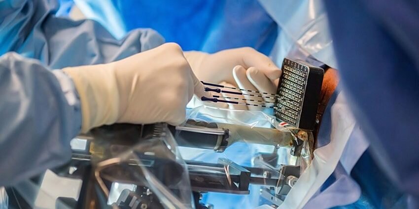 Медкор, Брахитерапия - как локальная лучевая терапия