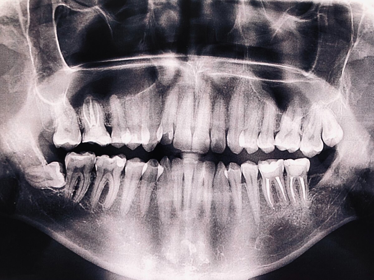 Снимок сломанной челюсти
