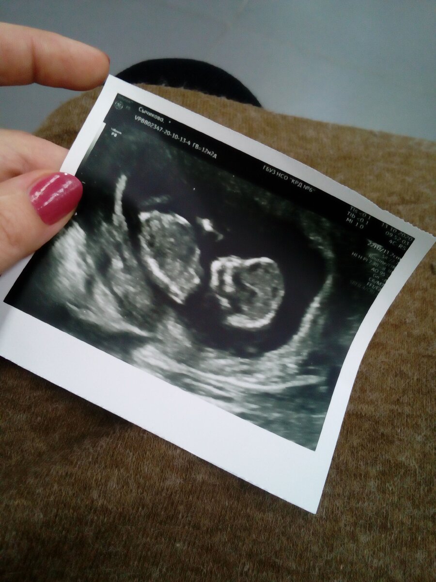 УЗИ. 12 недель.