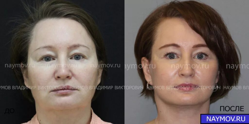 Оперировал пластический хирург Наумов Владимир Викторович