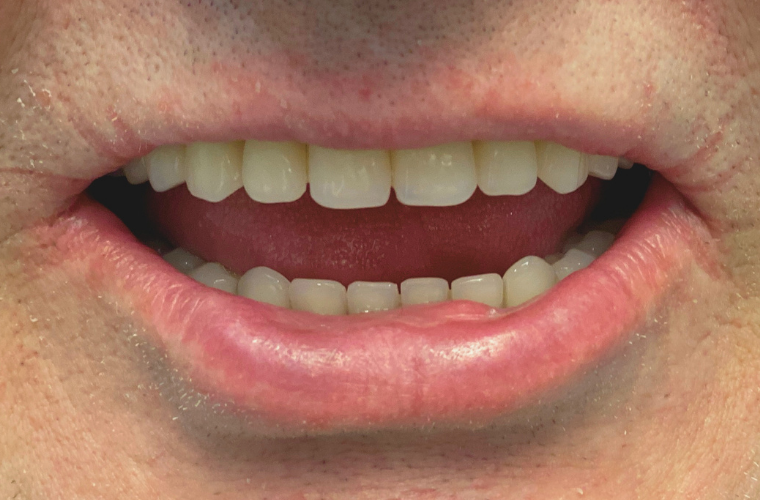 Пациенту проведена имплантация all-on-4