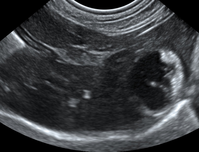 Рис.1 Ультразвуковая картина желчного пузыря при первичном обращении