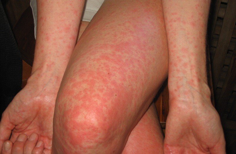 Какой вид сыпи характерен для аллергии