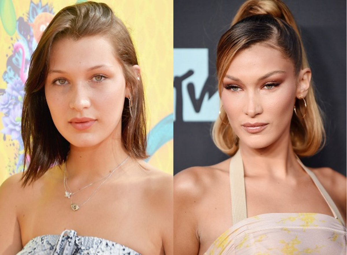 Белла Хадид до и после удаления комков Биша