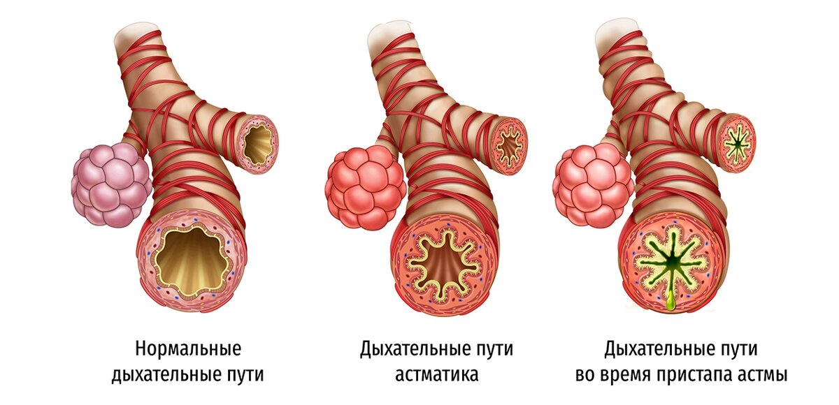 Бронхиальная астма — симптомы, диагностика и лечение | Клиника «Альфа-Центр Здоровья»