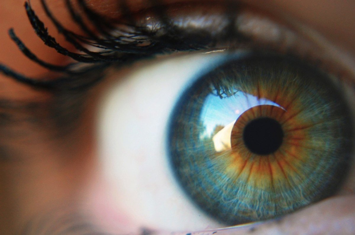 Один глаз серый другой. Центральная гетерохромия зеленый Карий. Центральная гетерохромия радужной оболочки. Центральная гетерохромия карих глаз. Гетерохромия Радужки глаз.