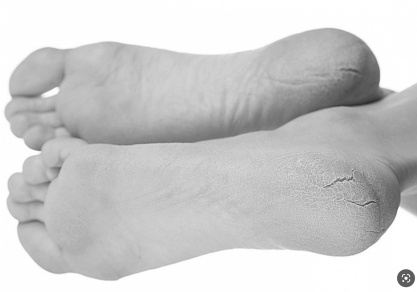 Лечим трещинки на пятках