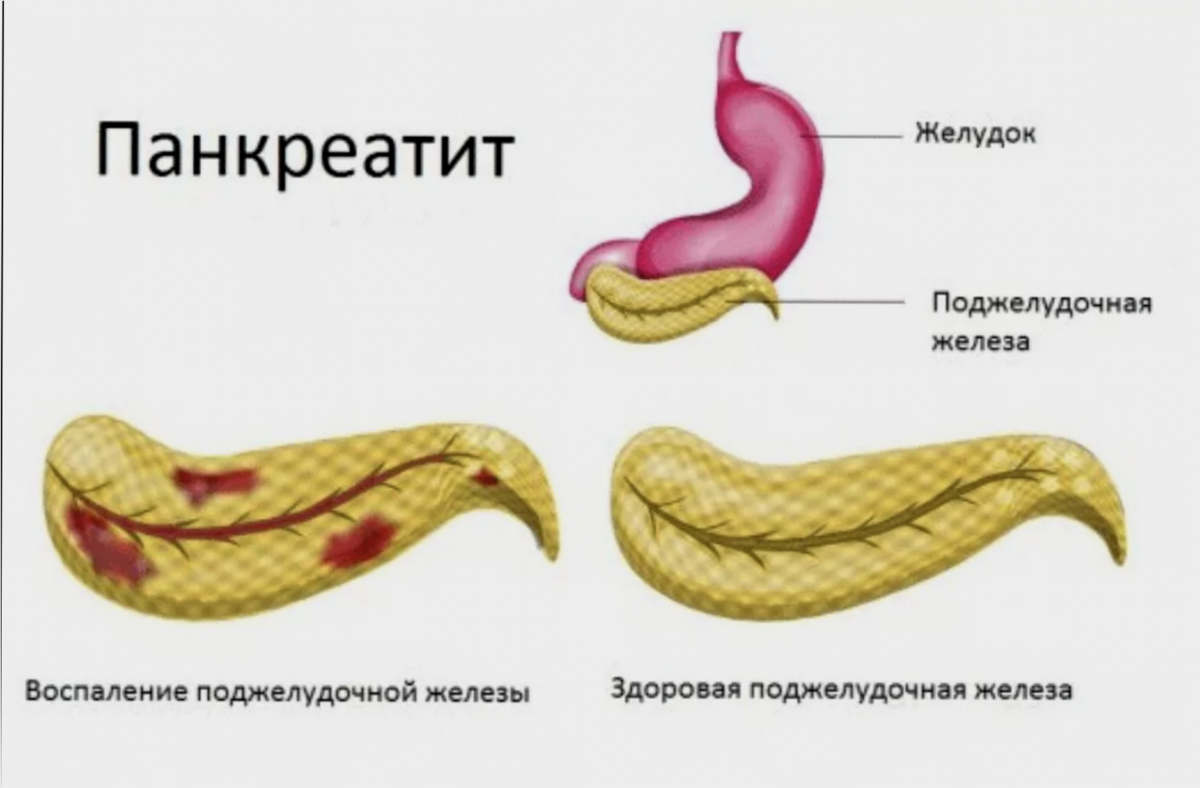 Поджелудочная железа хроническое заболевание