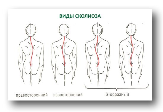 Сколиоз позвоночника