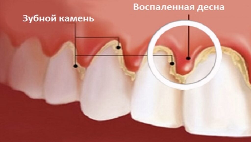 Кровоточат десны витамины