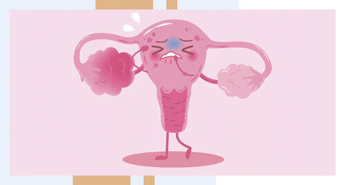 Поликистоз яичников