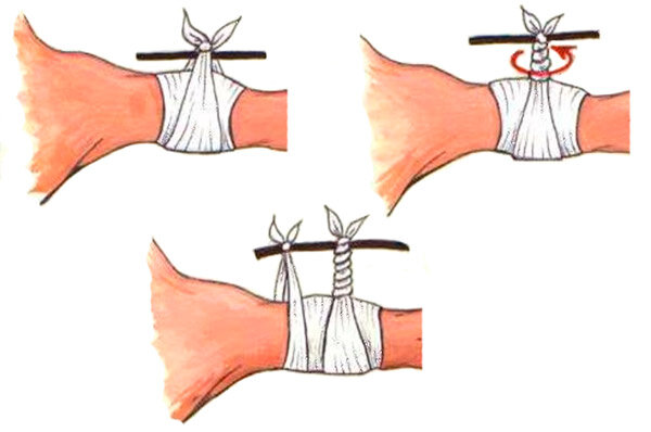 Остановка кровотечения косынкой со скруткой (изображение из открытых источников)