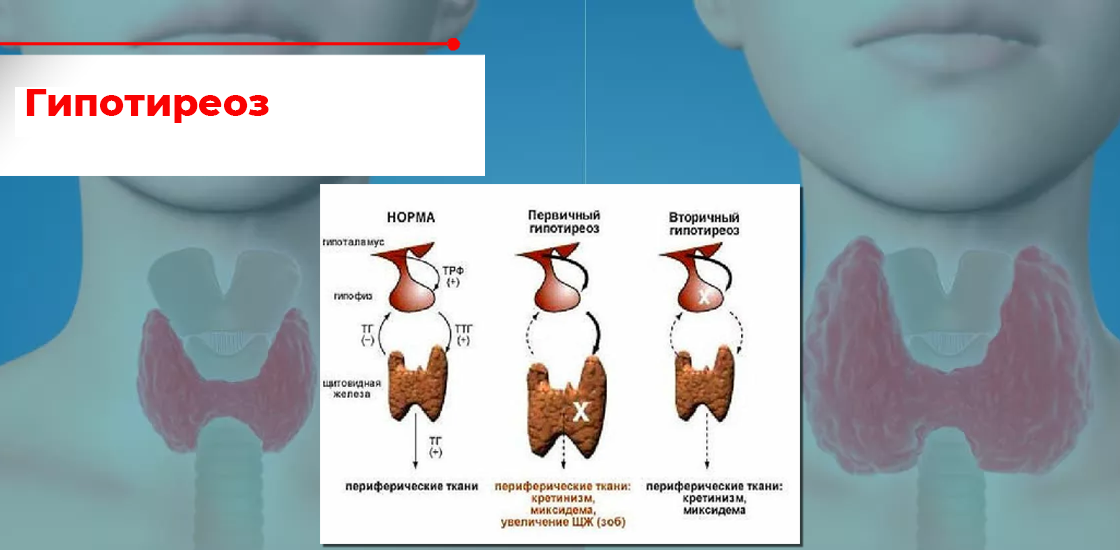 Тиреоидит отзывы. Хронический тиреоидит. Микседема аутоиммунный тиреоидит. Хронический аутоиммунный тиреоидит. Аутоиммунный тиреоидит внешность.