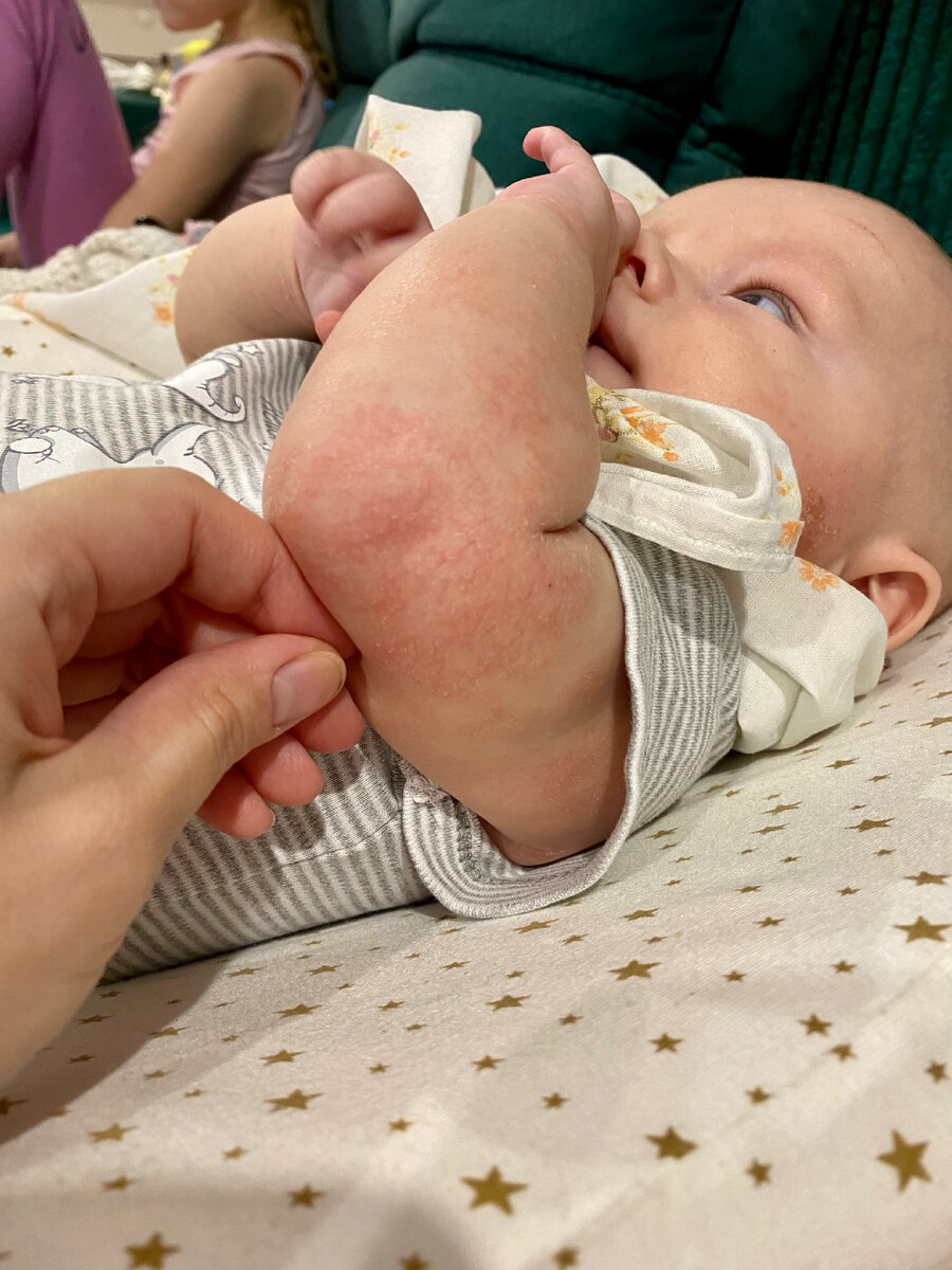 Я просто не могла спокойно смотреть на его шелушавые ручки, становилось так жалко его и хотелось как можно быстрее помочь ребёнку  