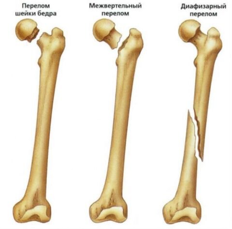  Диафизальным переломомом бедра считается перелом кости от подвертельной зоны сверху и до надмыщелковой снизу.