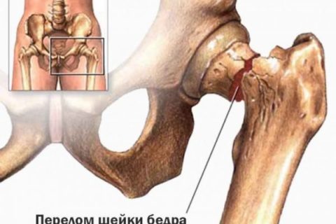  Можно ли сидеть при переломах шейки бедра – надо знать каждому пациенту, перенесшему данную травму.