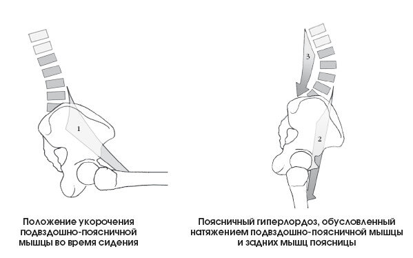 Почему так получается? Не готовое к нагрузке тело при корявой технике выполнит движение чем угодно, лишь бы решить задачу. Поскольку двигательного контроля не достаточно, оно будет использовать те мышцы, о существовании которых знает - квадратную мышцу поясницы, всю группу разгибателей поясничного отдела. Подвздошная у человека сидячего укорочена в принципе. Это сильно усложняет движение в тазобедренном суставе.