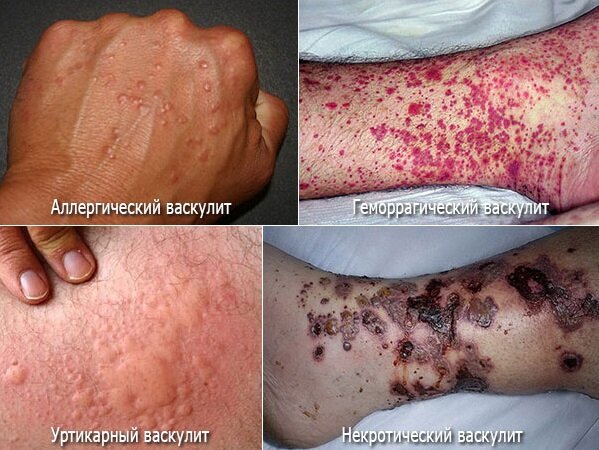 Виды васкулита