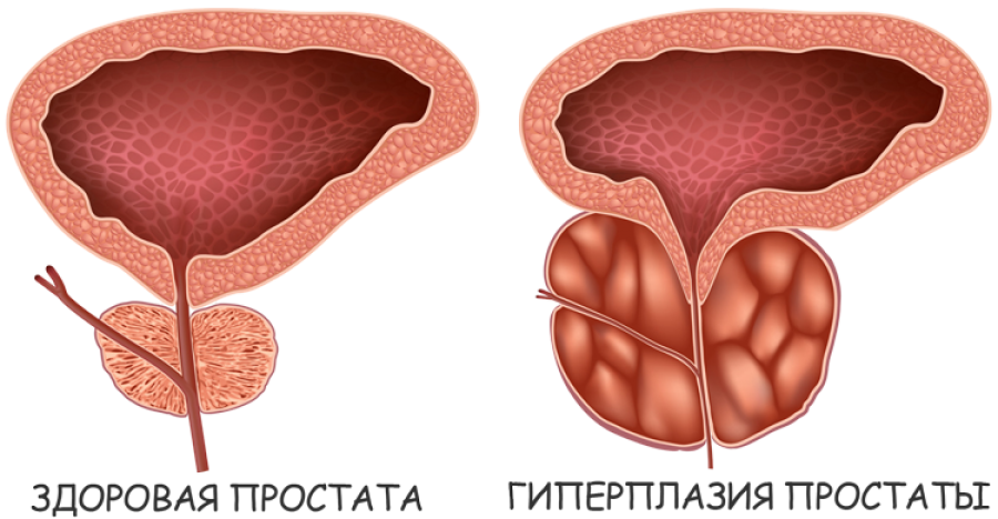 Простатит ᐉ диагностика, лечение в МЦ 