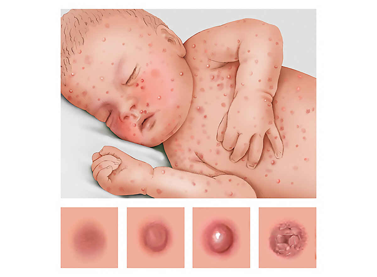 Так изменяется сыпь при ветрянке: красное пятно превращается в бугорок на коже, потом в волдырь и, наконец, в болячку с сухой корочкой 
